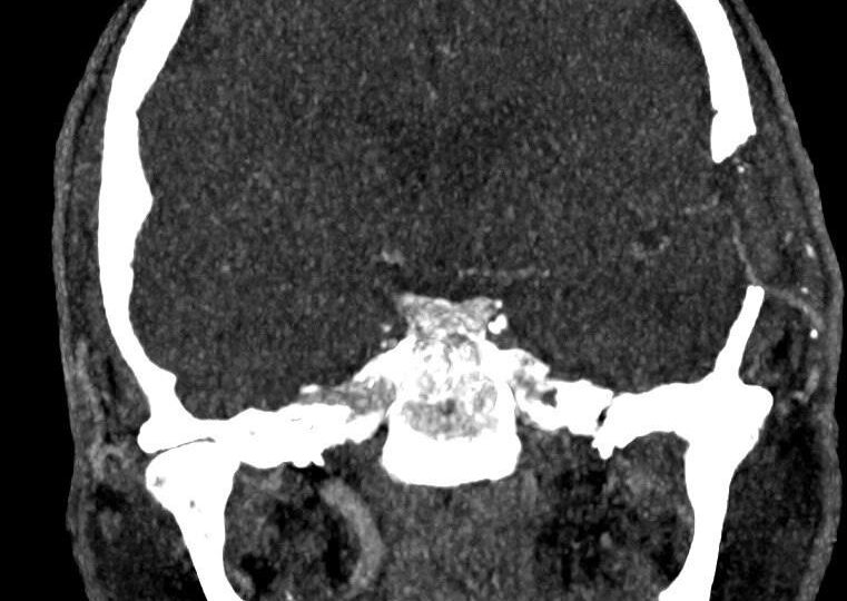 Мужчину с инсультом спасли в Истринской больнице