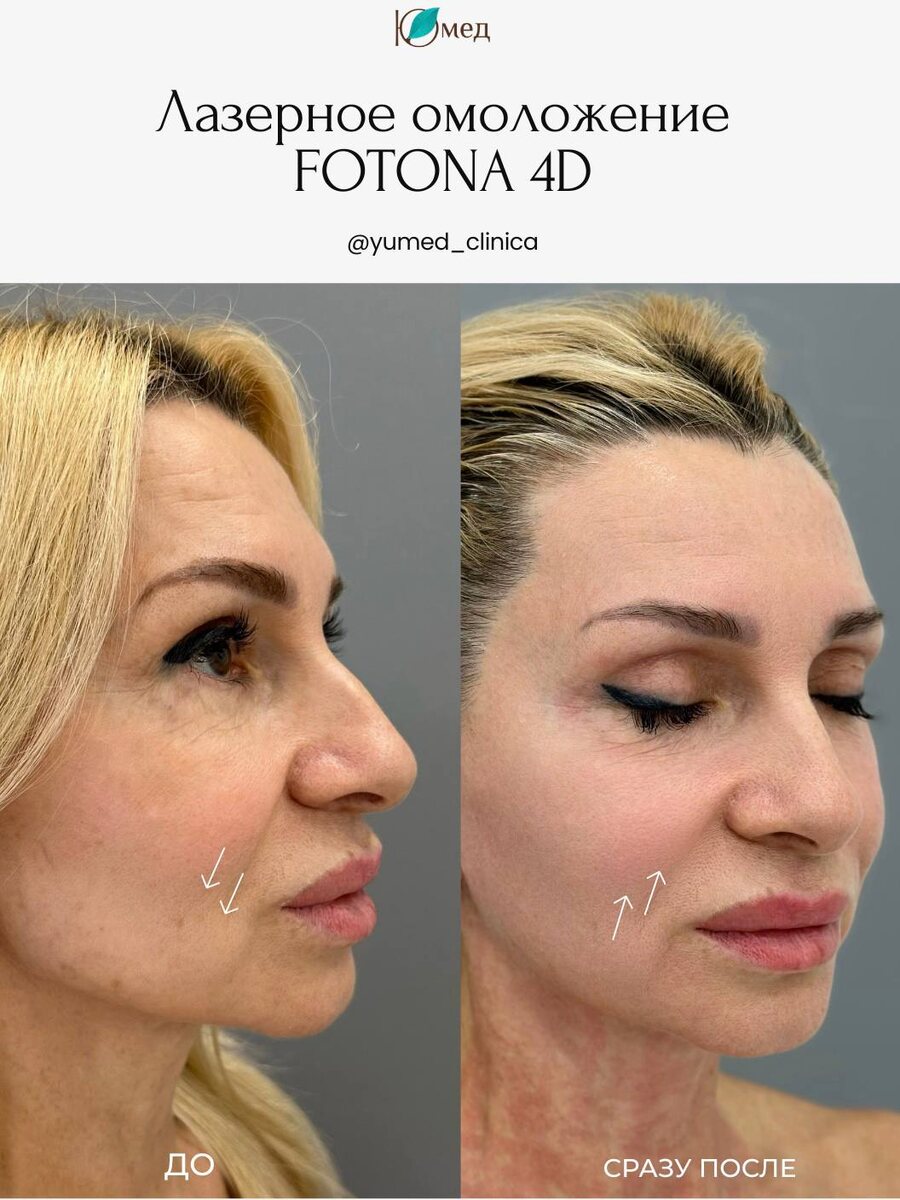 Результат до/сразу после процедуры на FOTONA 4D