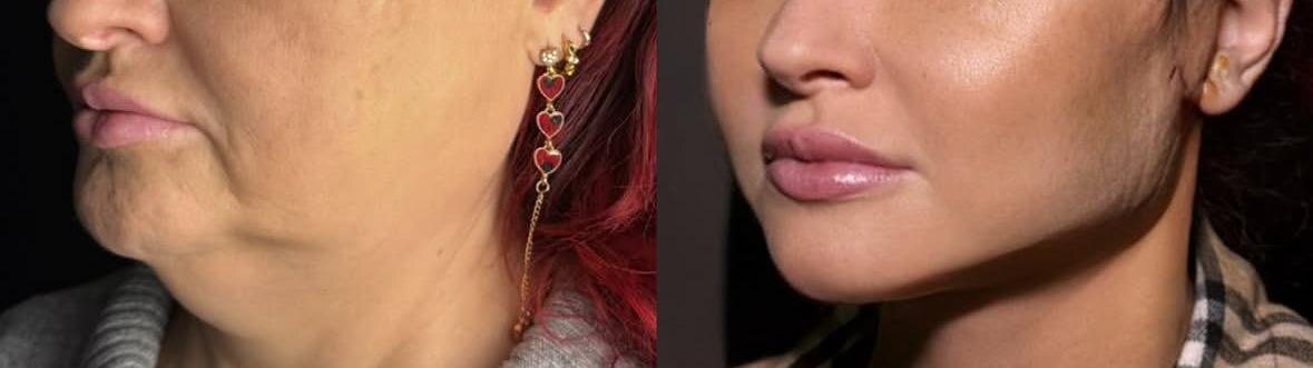 Фото взято из открытых источников (реальные соцсети клиник и хирургов) в качестве иллюстрации. Лица пациентов специально обрезаны. 