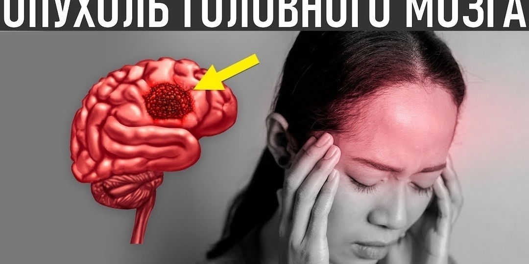Когда Головная Боль — Это Не Давление, А Скрытая Опухоль