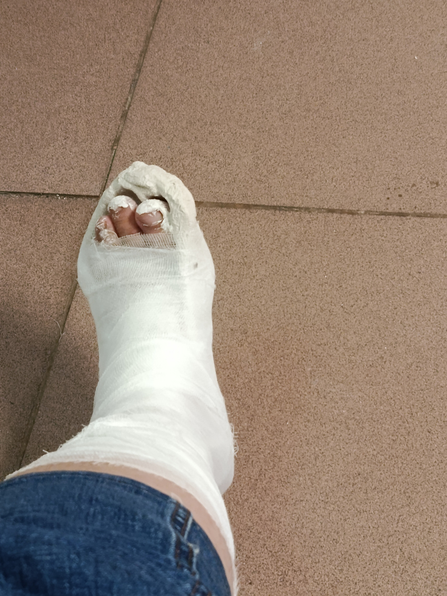 Вот это первое фото с гипсом. В шоковом весёлом состоянии настроении. 