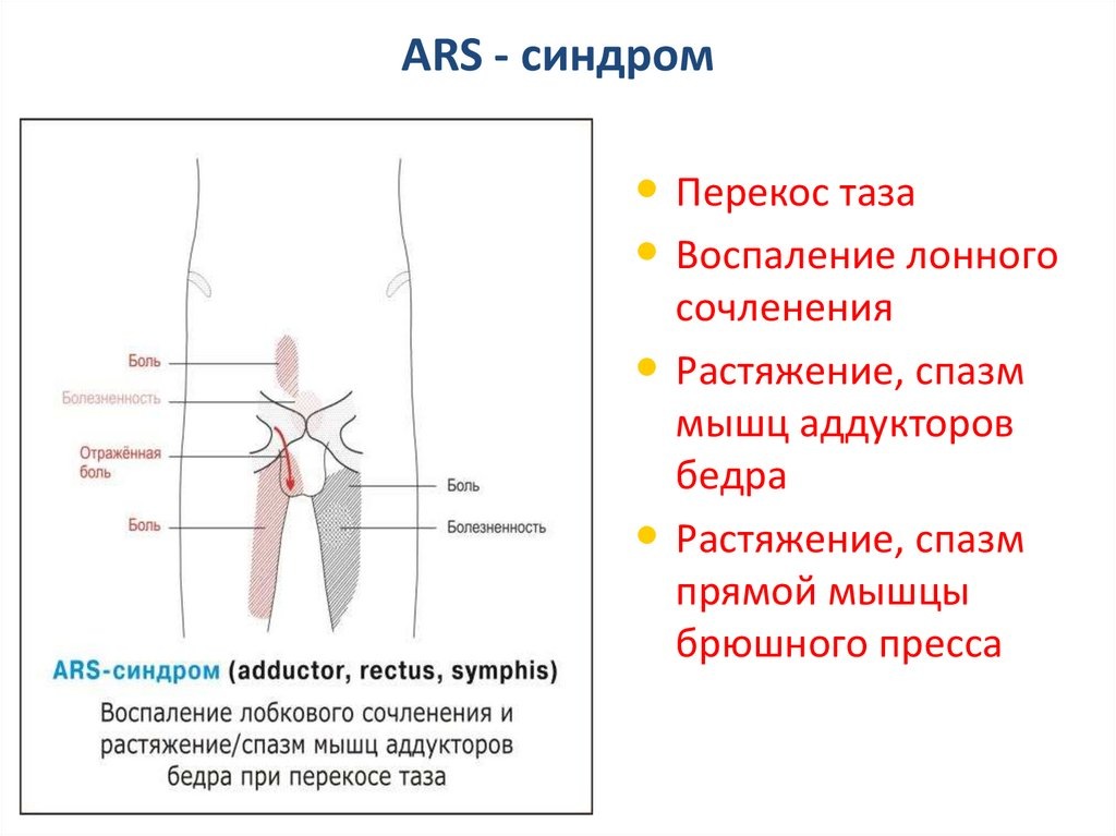 на картинке изображен ARS синдром и анатомия мышц бедра
