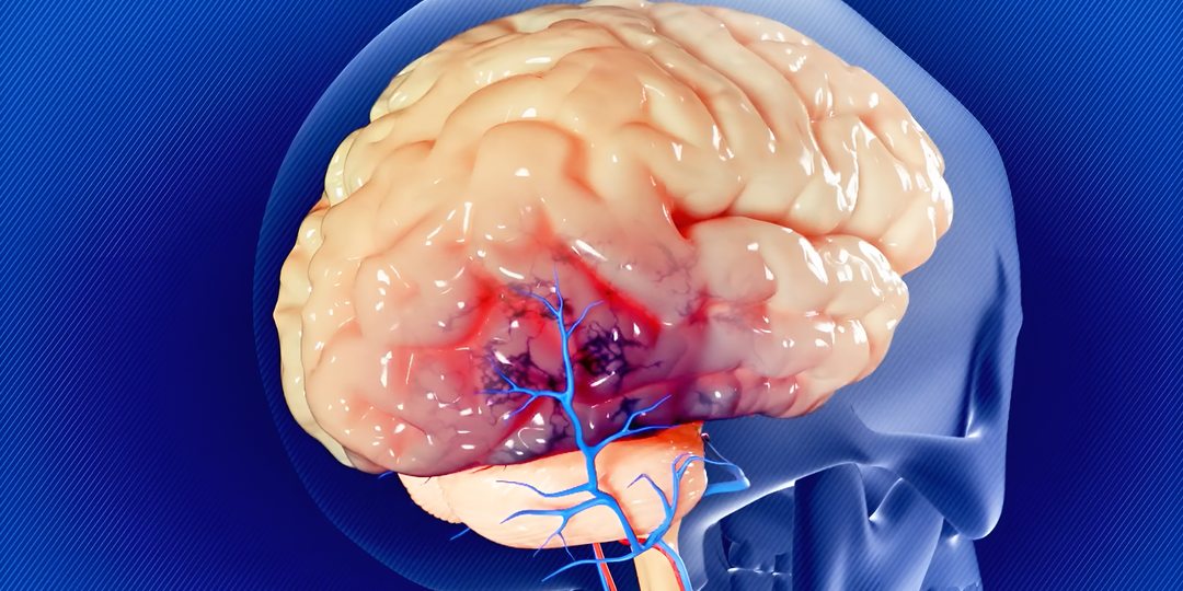 Удавка для вашего мозга: как упражнениями убрать головную боль, головокружение, туман в голове?
