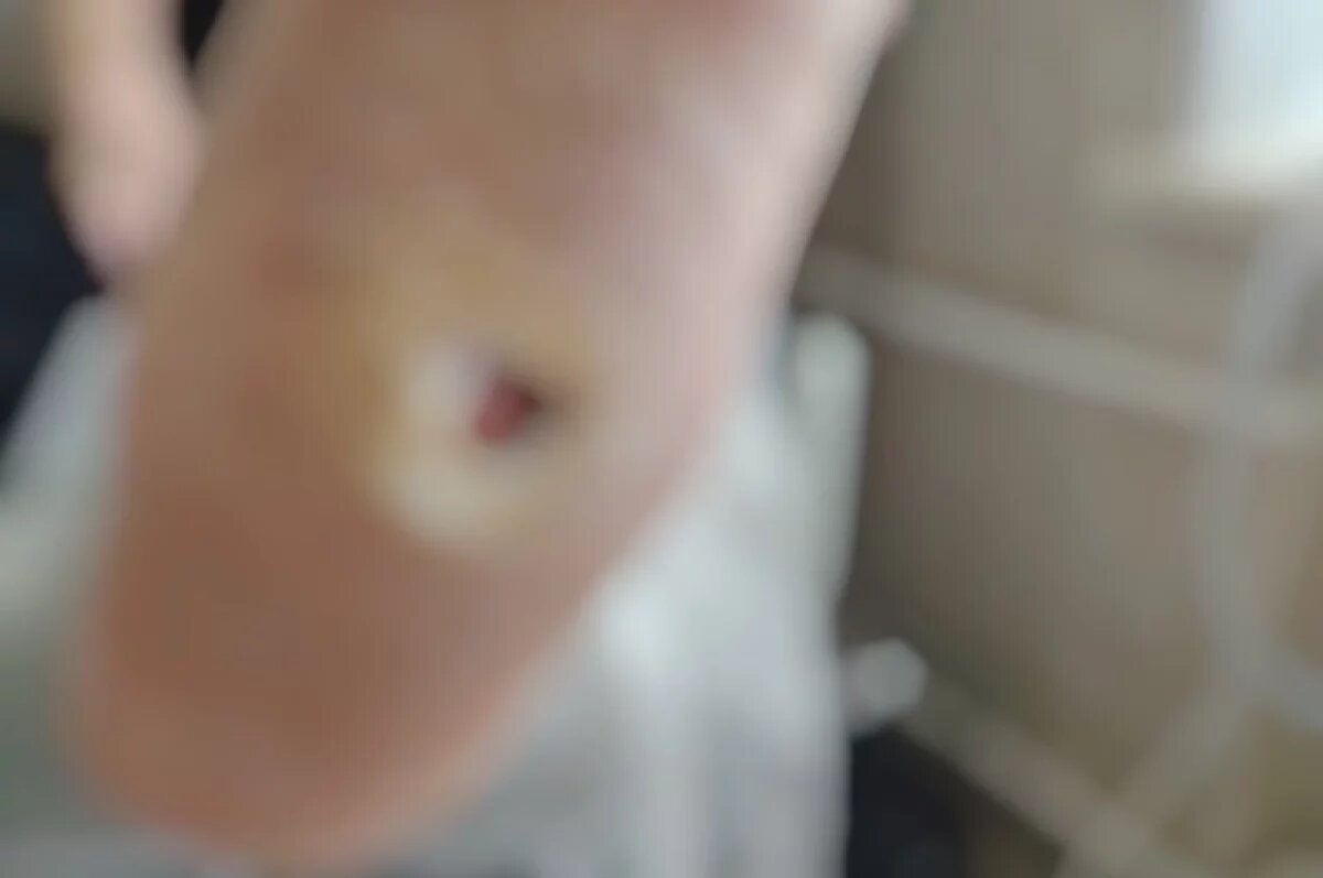    Рязанские медики спасли пациентку от ампутации стопы