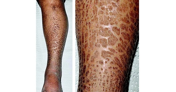 Ороговение кожи при болезни Рефсума