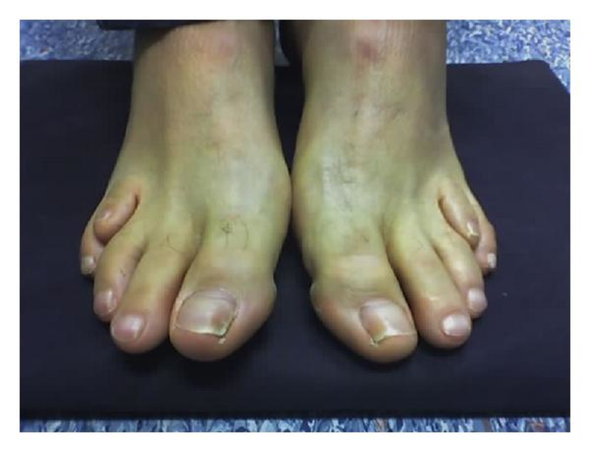 Укорочение 4-го пальца стопы у пациента с болезнью Рефсума