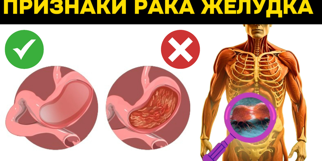 Ранние сигналы рака желудка: сравнение с диспепсией вводит в заблуждение