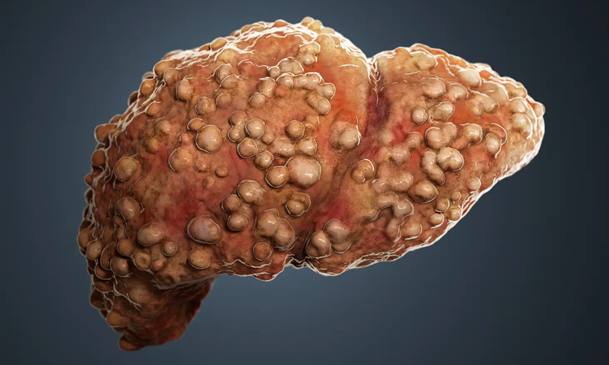     Цирроз печени — это хроническое заболевание, при котором здоровая ткань печени постепенно замещается рубцовой. Фото: Unsplash