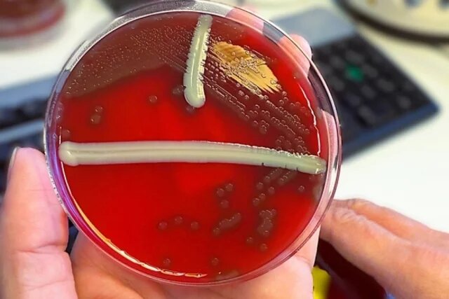    Что такое газовая гангрена?