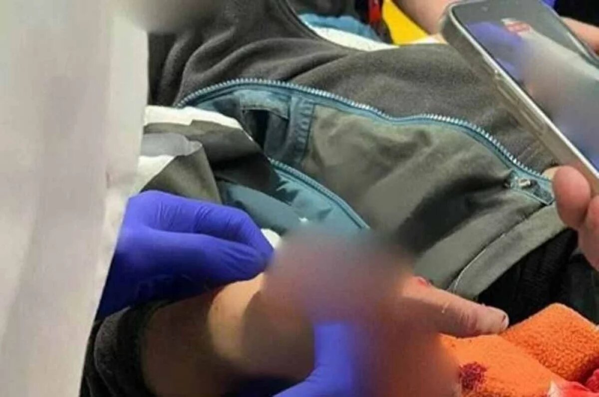    Ребенок госпитализирован с ампутацией нескольких пальцев руки.