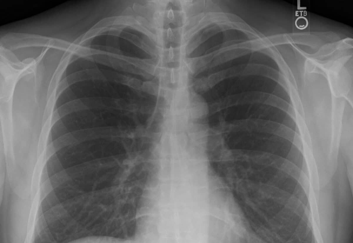    Рентгенограмма грудной клетки в прямой проекции / © Stillwaterising, Wikipedia