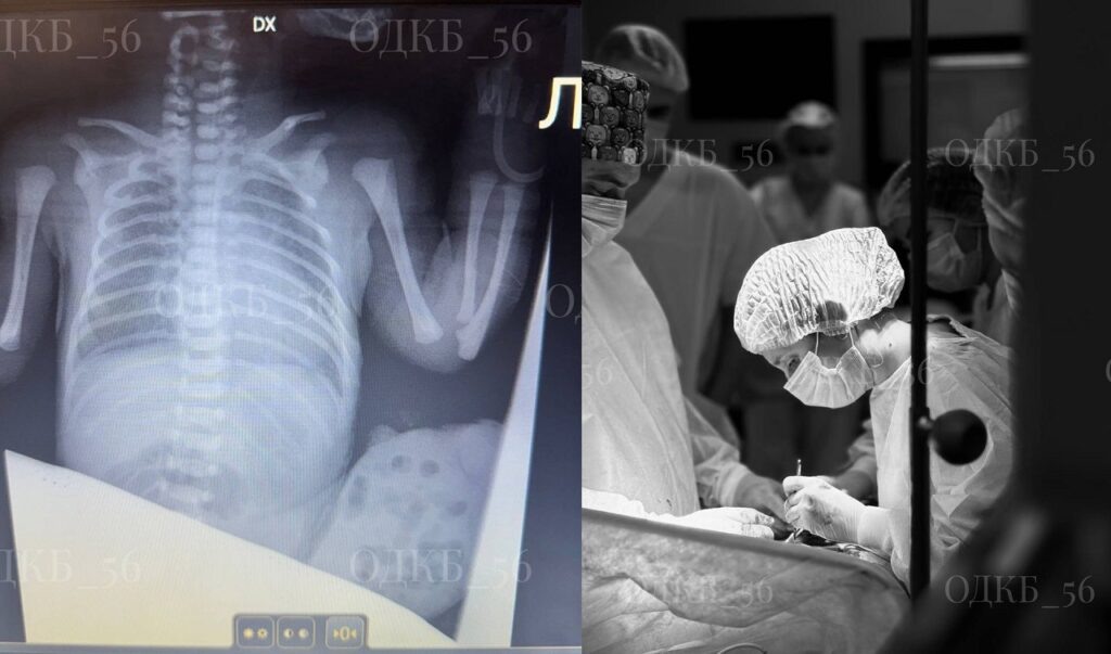    Оренбургские хирурги спасли новорожденного с редкой патологией Оренбуржье