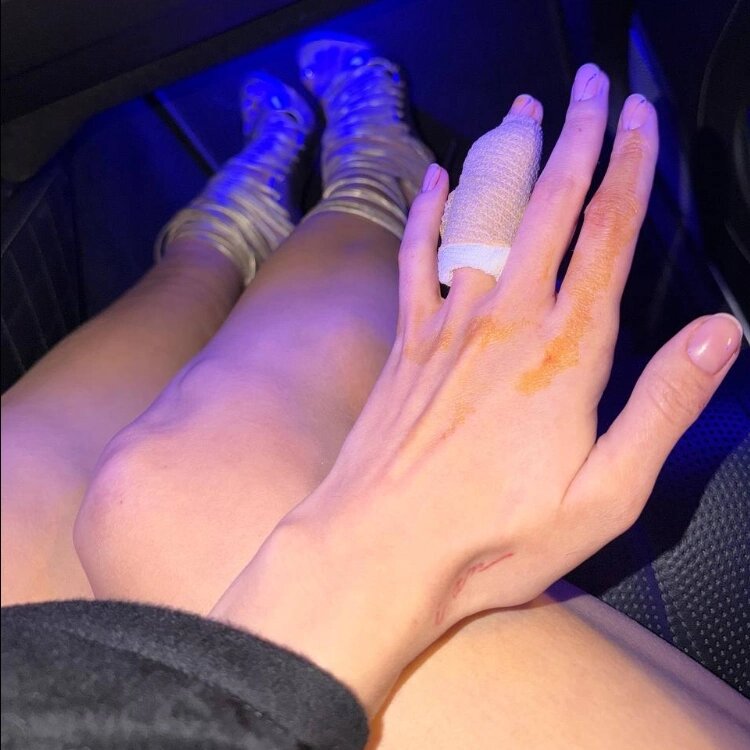 День рождения Вали Карнавал закончился наложением швов📷
