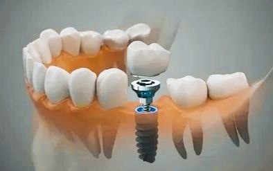 Имплантация шестёрки. С просторов интернета.