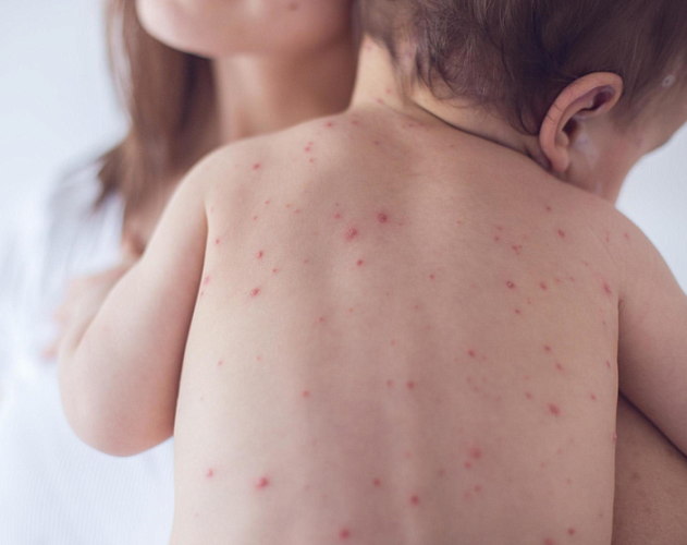 Корь — одно из самых заразных вирусных заболеваний, известных человечеству. Один заболевший способен передать инфекцию девяти из десяти непривитых контактировавших с ним людей.