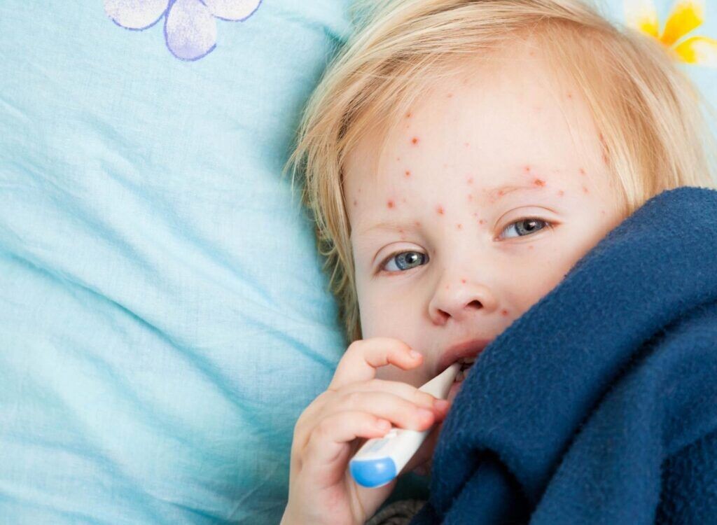 Вирус кори распространяется воздушно-капельным путем — при кашле, разговоре, чихании. Для заражения достаточно просто находиться в одном помещении с больным.