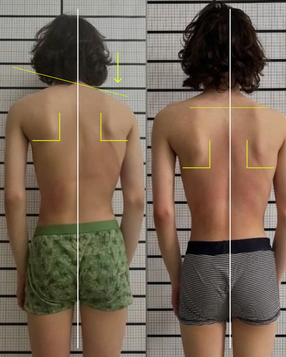 Результат после 5-ти остео-сеансов