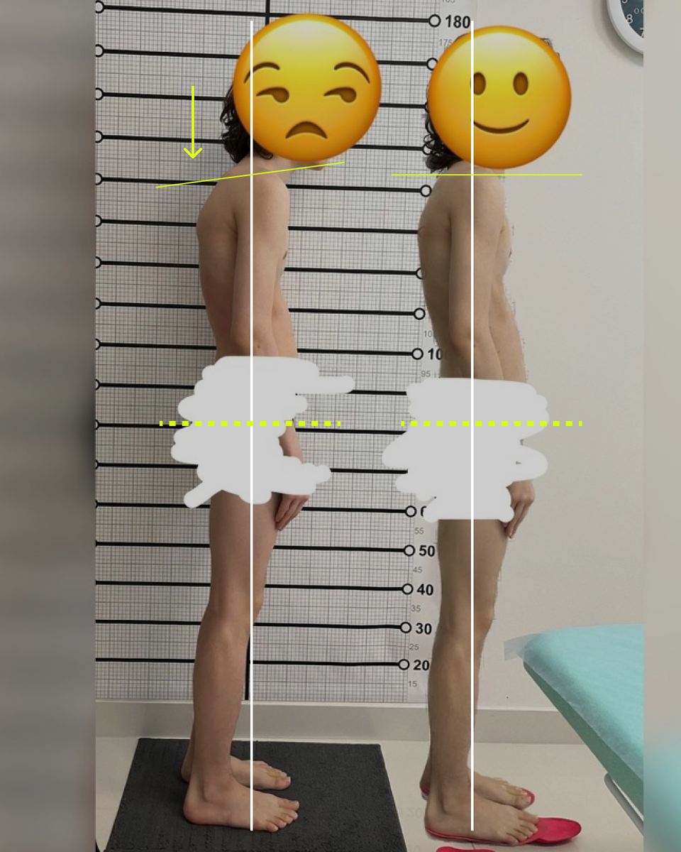 Результат после 5-ти остео-сеансов