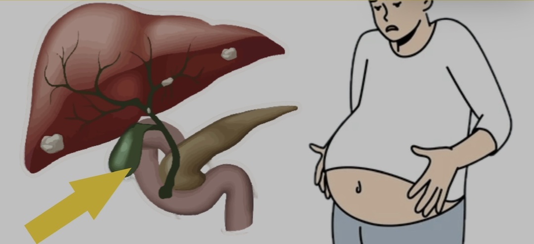 Заброс желчи в желудок: почему гастроэнтерологи отвергают устаревший диагноз