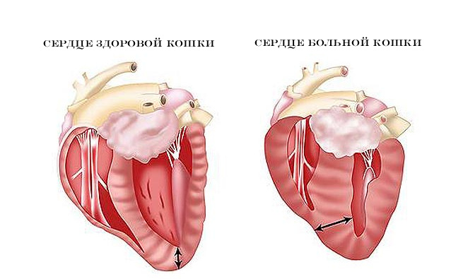 При ГКМП стенки сердца утолщены, кровь хуже циркулирует, увеличивается нагрузка. Что, при отсутствии терапии, может привести к сердечной недостаточности и отеку легких