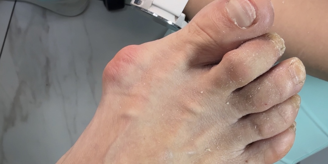 Халюс Вальгус: влияние на ногти