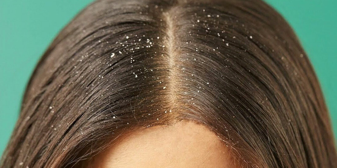 Перхоть: почему появляется и как с ней справиться