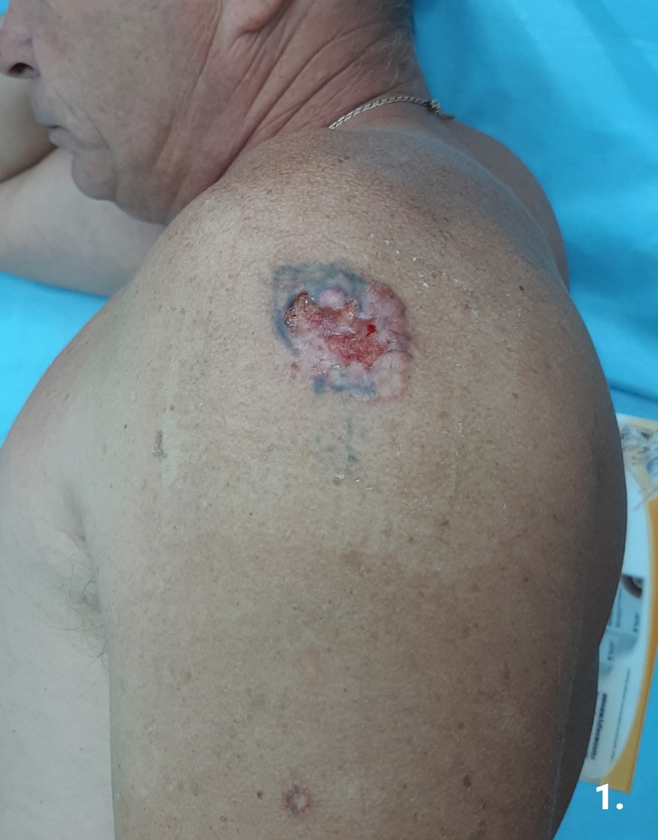 Фото 1. Перед операцией. Общий вид новообразования кожи плеча.