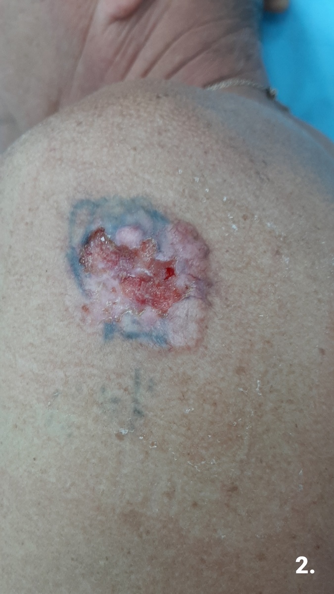 Фото 2. Детальное фото перед операцией. Границы опухоли достаточно чётко видны.