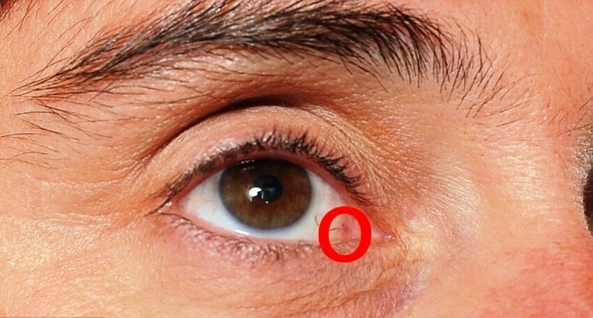 Офтальмолог Объяснил, Почему Глаза Первые Реагируют На Опухоль (интервью)