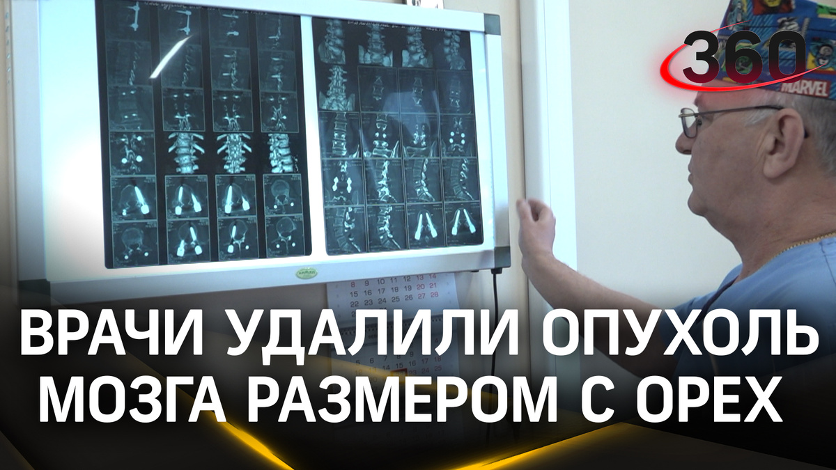 История: врач заметил опухоль мозга по изменению зрачков