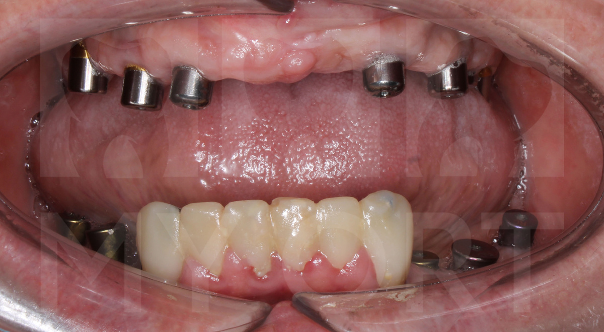 Коронки на нижней челюсти с 43 по 33 зуб