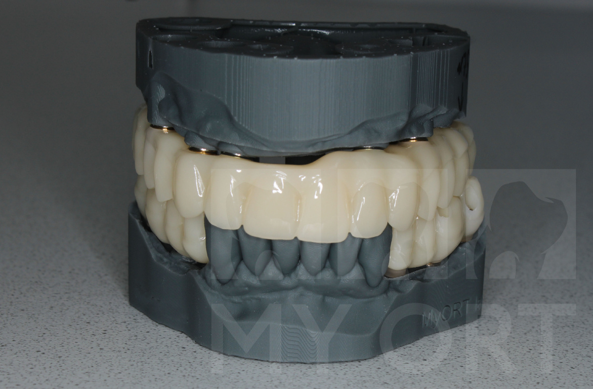 Временные конструкции созданные по цифровому протоколу в зуботехнической лаборатории MY ORT LAB