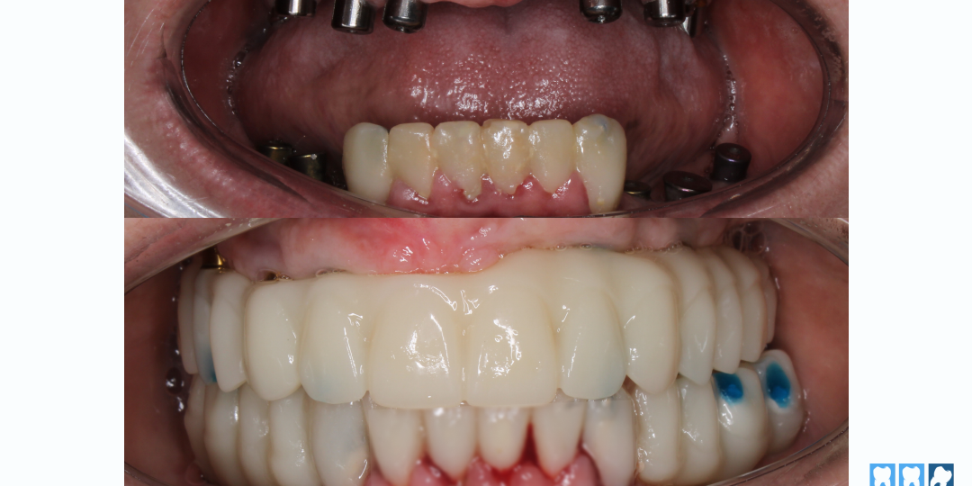 Как мы исправили чужую ошибку и вернули радость жизни пациенту: сложный случай из практики