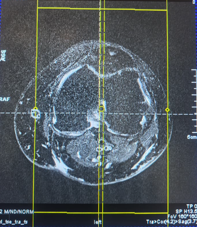 Артефакты на коленной катушке 14CH Extremity Coil — 10353300