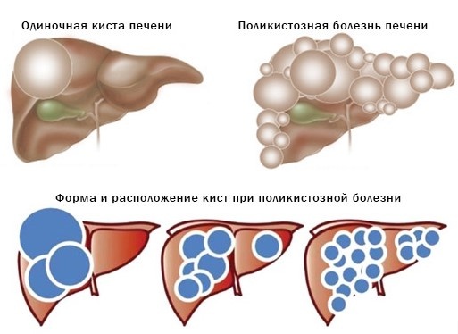Киста в печени: стоит ли бить тревогу — или это не так страшно, как кажется?