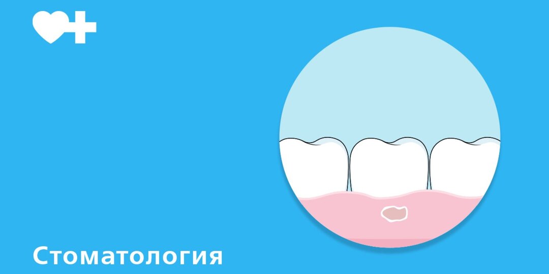 Частые стоматиты у детей: причины, которые родители не всегда замечают