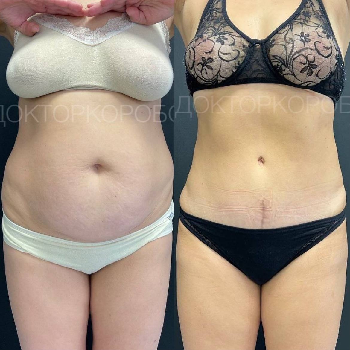 Абдоминопластика с ушиванием ДИАСТАЗА и пупочной грыжи, липосакция живота, пояснично-боковых областей и спины. Результат через 9 месяцев после операции.