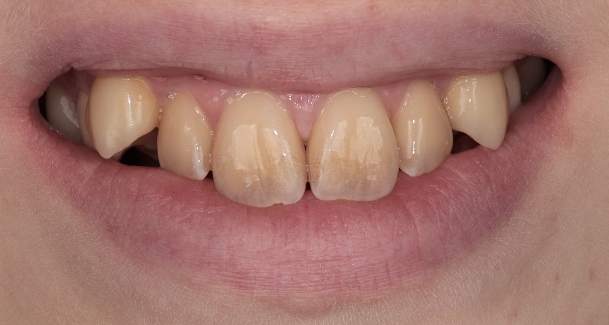 Вестибулярное супраположение клыков