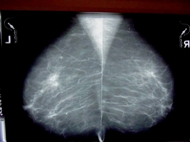 Маммограмма. Полсекунды — и специалист что-то заподозрил.