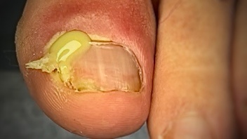 Гнойный панариций при вросшем ногте