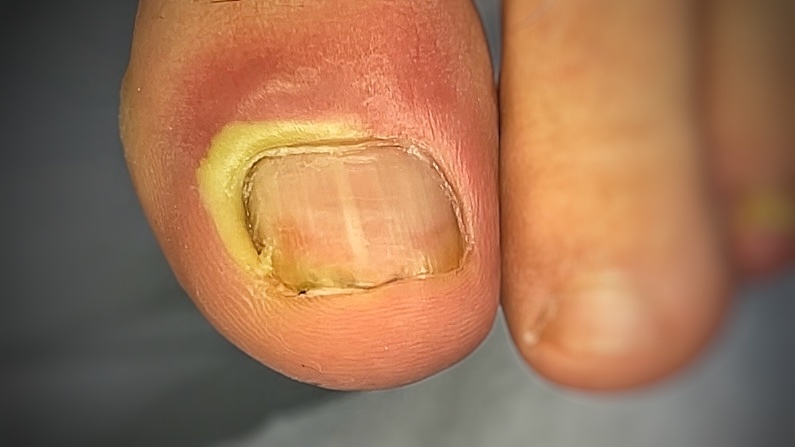 Гнойный панариций при вросшем ногте 