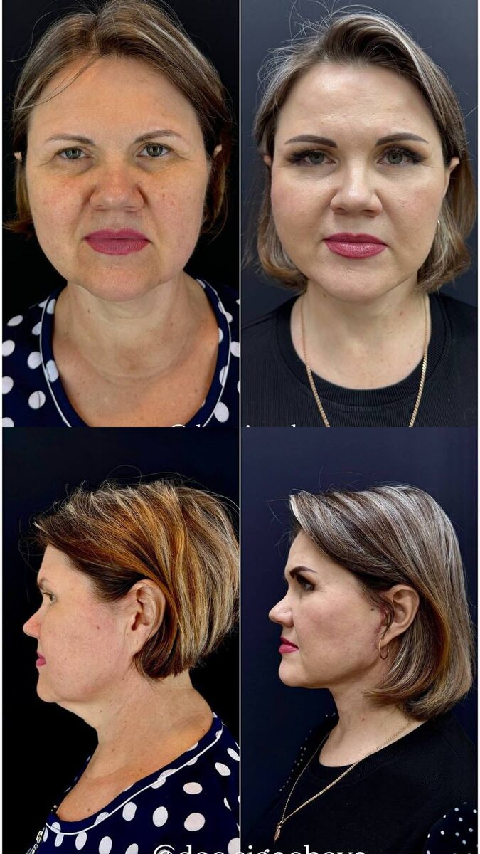 1. На фото – работа Татьяны Валерьевны Служивой (Сигачевой), SMAS-подтяжка лица по Мендельсону. Срединная платизмопластика 🤩 