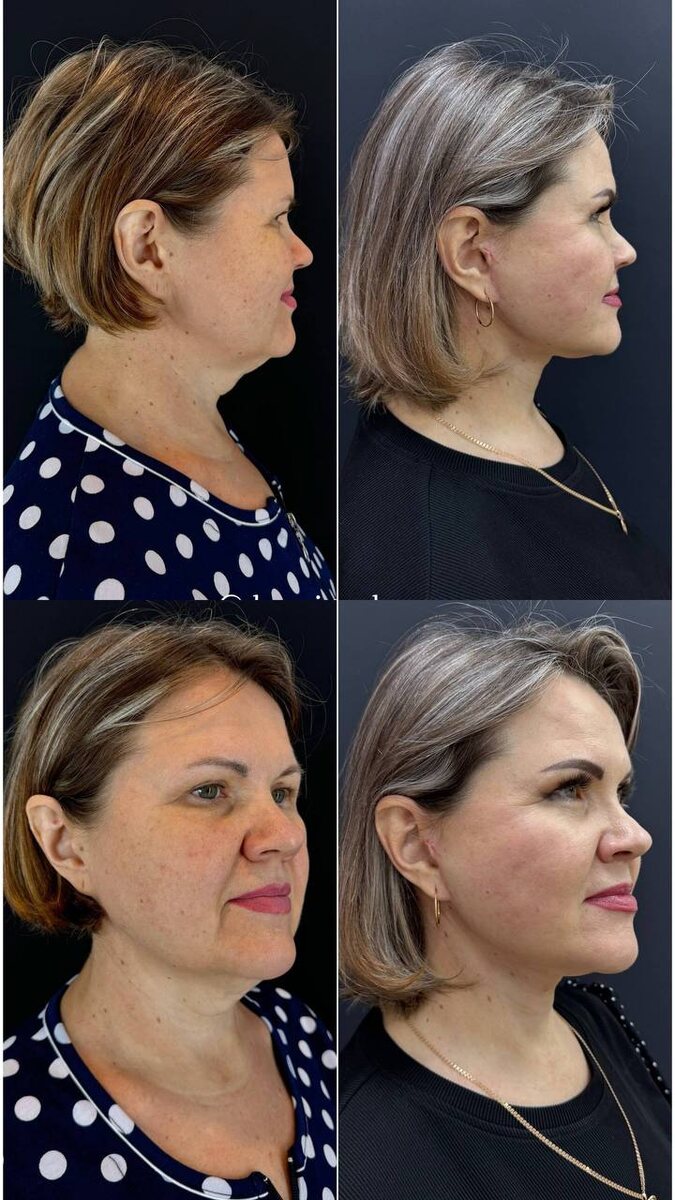 2. На фото – работа Татьяны Валерьевны Служивой (Сигачевой), SMAS-подтяжка лица по Мендельсону. Срединная платизмопластика 🤩 