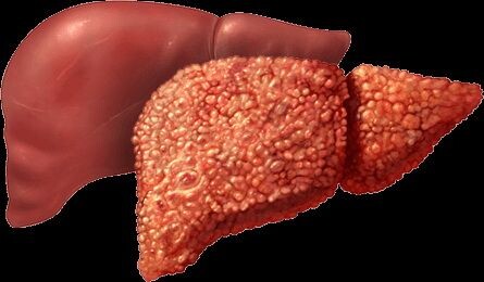 Цирроз печени: как распознать, остановить и жить дальше