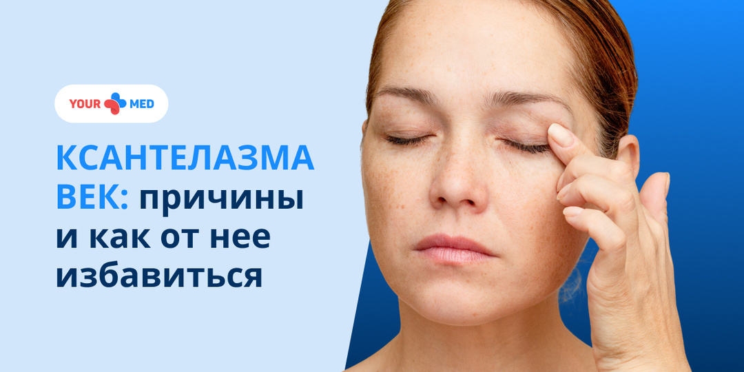 Ксантелазма век: причины и как от неё изабиться