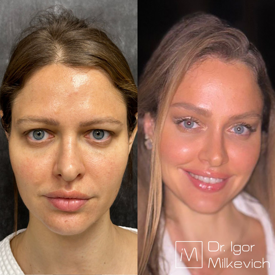 Выполнена эндоскопическая подтяжка лба