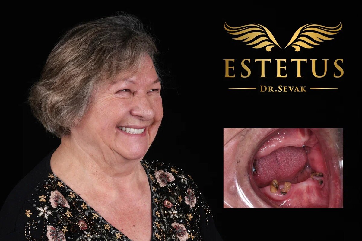 Надежда Валеевна, 84 года. г. Москва, клиника доктора Севака Estetus 