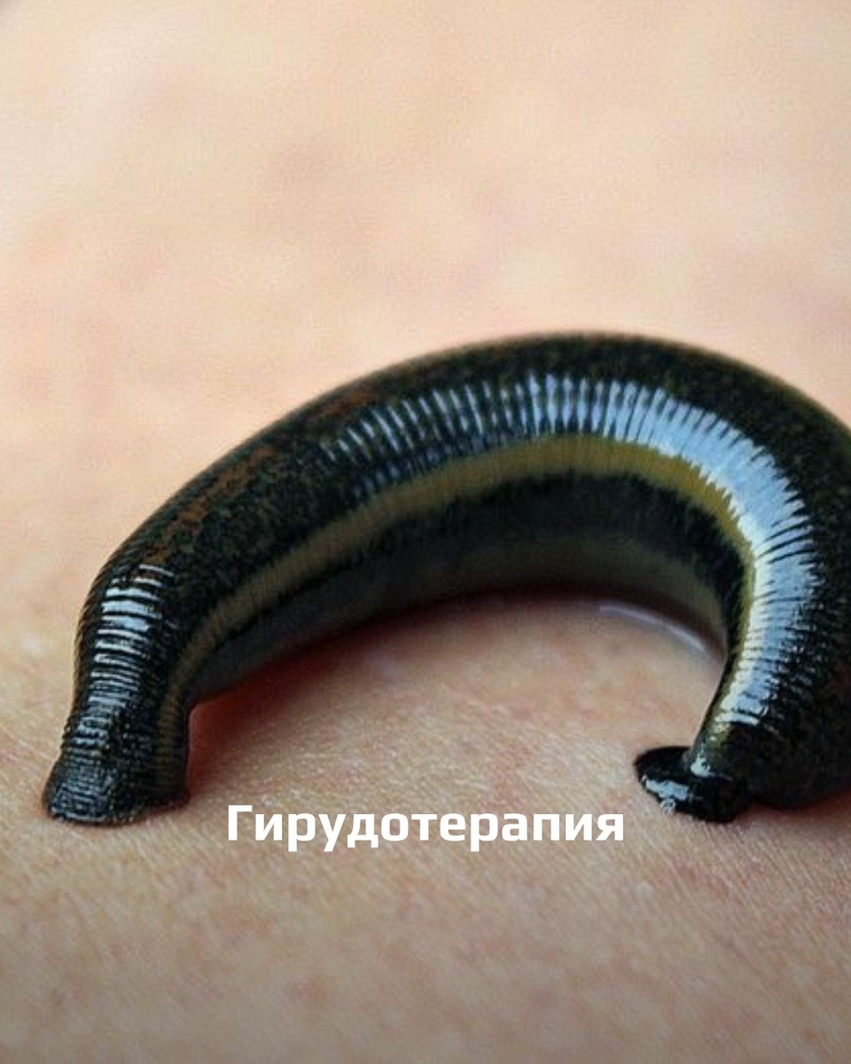 Гирудотерапия, или лечение с помощью медицинских пиявок