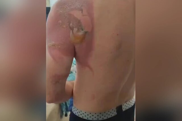    Сначала мужчина ничего не почувствовал, волдыри вышли на следующий день. Фото: АиФ-Казань