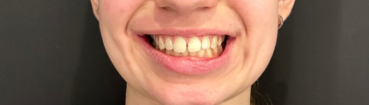 Диастема и много всякого разного 